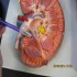مولاژ کلیه انسان ( kidney )