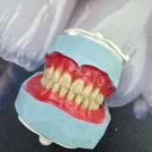 ساخت انواع دندان مصنوعی،ساخت پلاک کروم کبالت